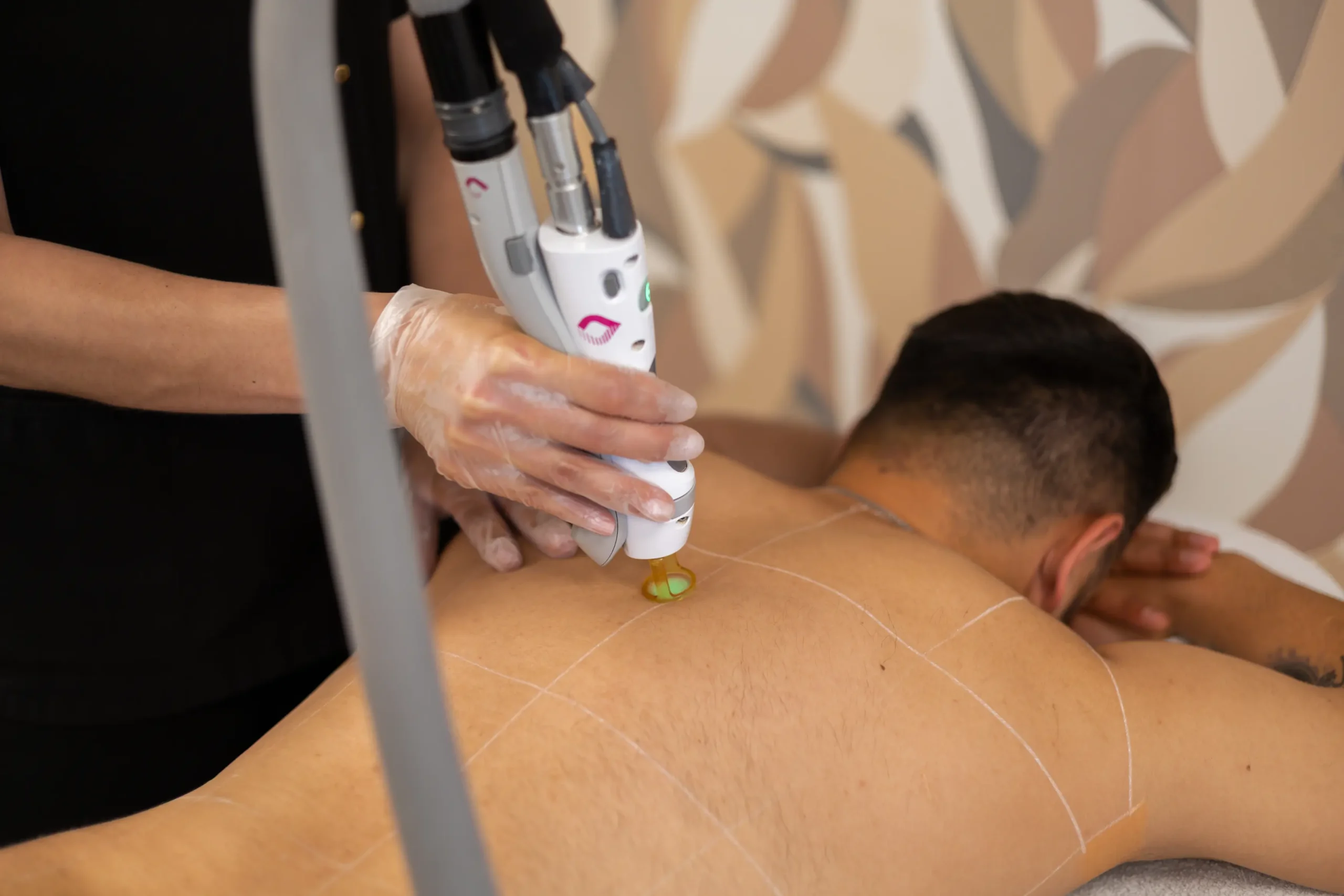 Laserontharing bij Polat Beauty voor definitieve haarvermindering