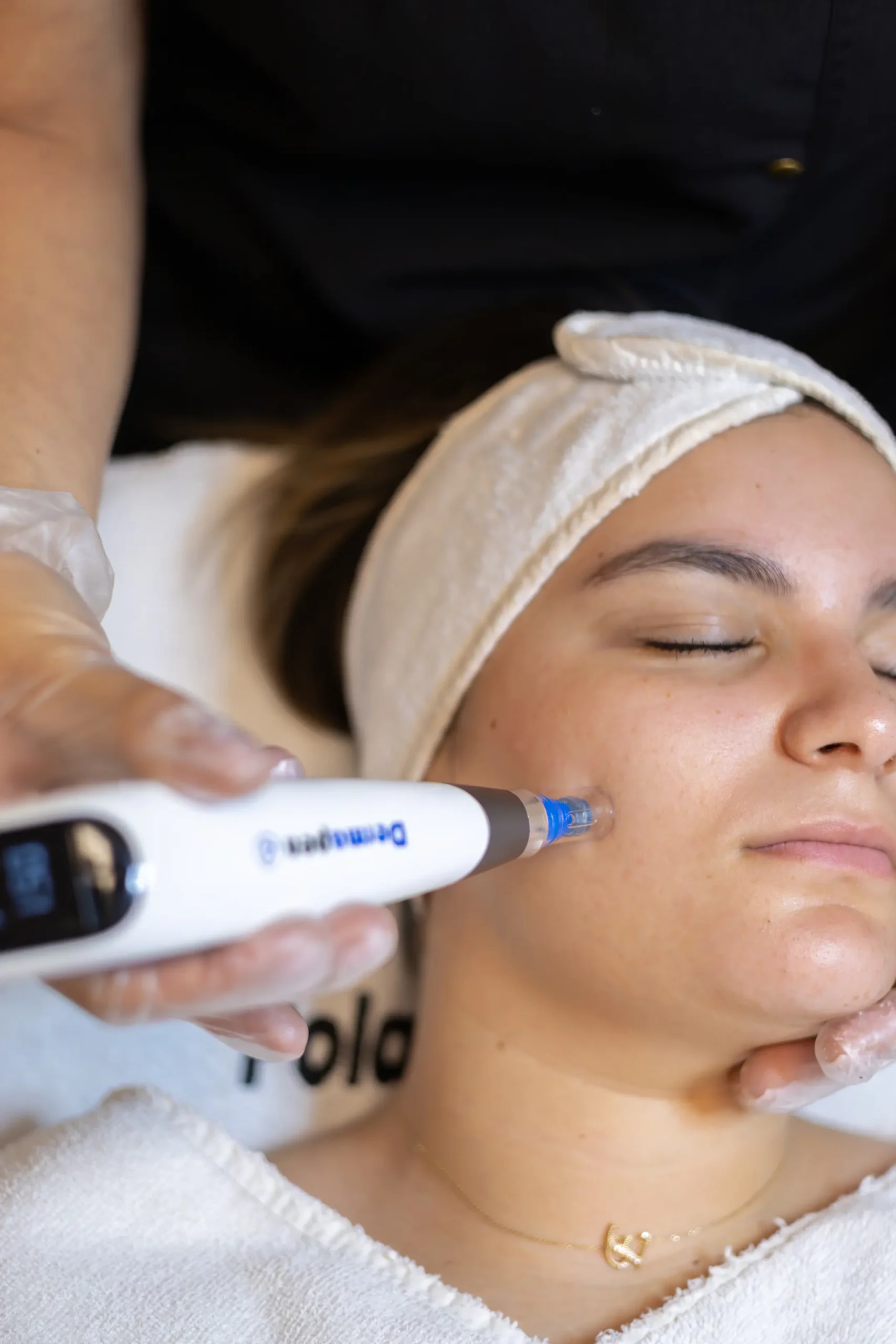 Microneedling Dermapen 4 Eindhoven voor huidverjonging en littekenbehandeling bij Polat Beauty