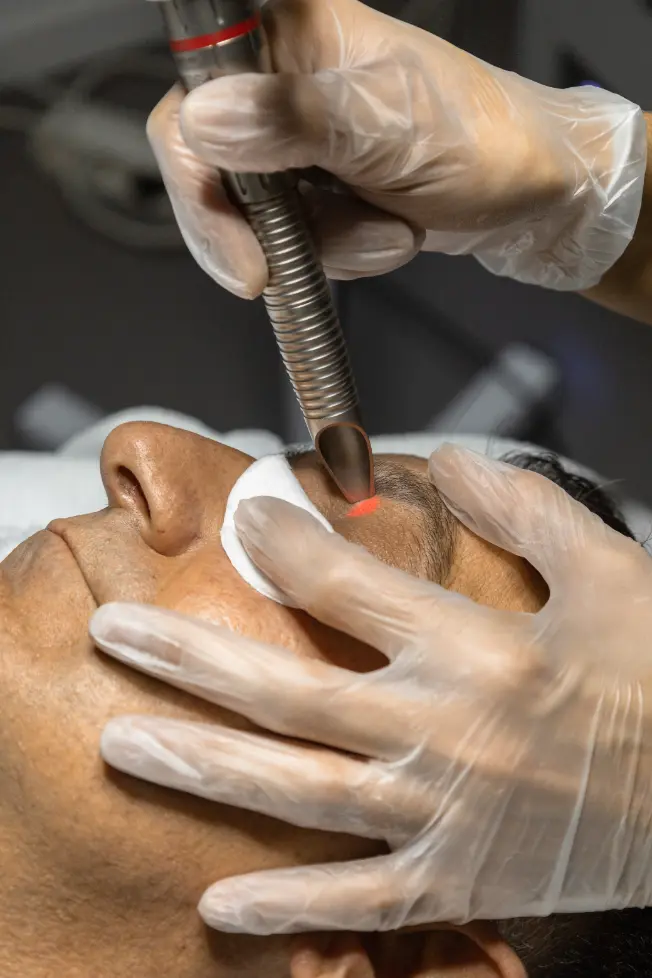 Fotona SP Dyamis laserenergie behandeling Polat Beauty Eindhoven smooth eye